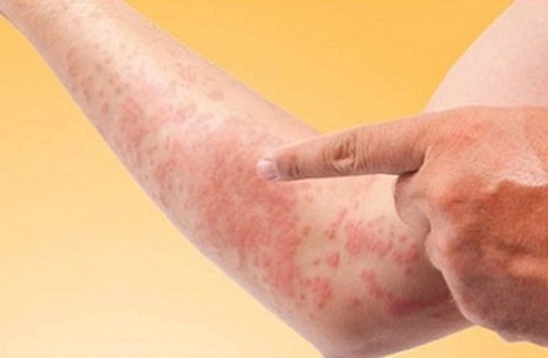 [Image: benh-di-ung-da.jpg]